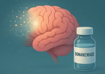 Imagem ilustrando a atuação do Donanemabe no cérebro